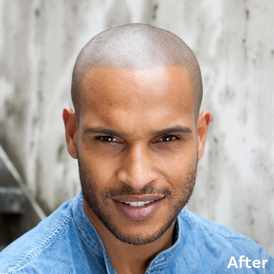 Scalp-Micropigmentation-Lloyd-After