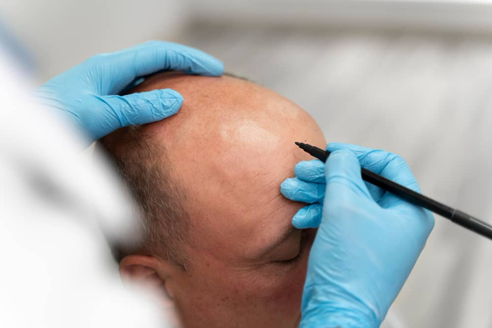 scalp-symmetry process