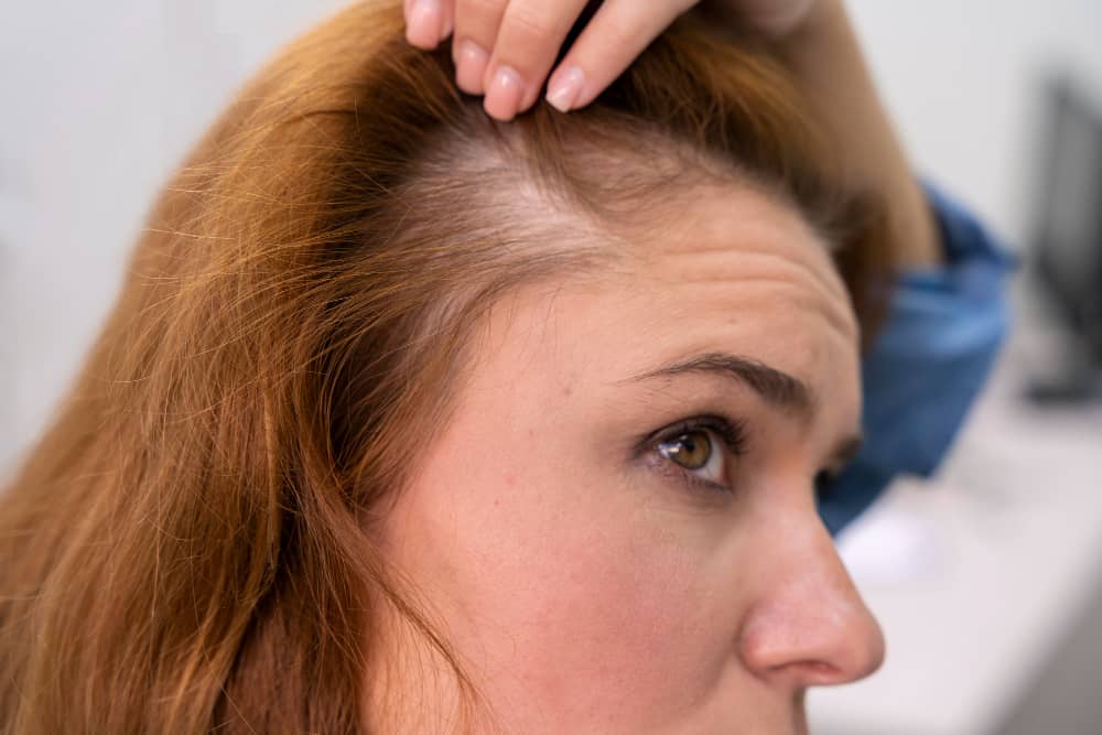 Women hair loss